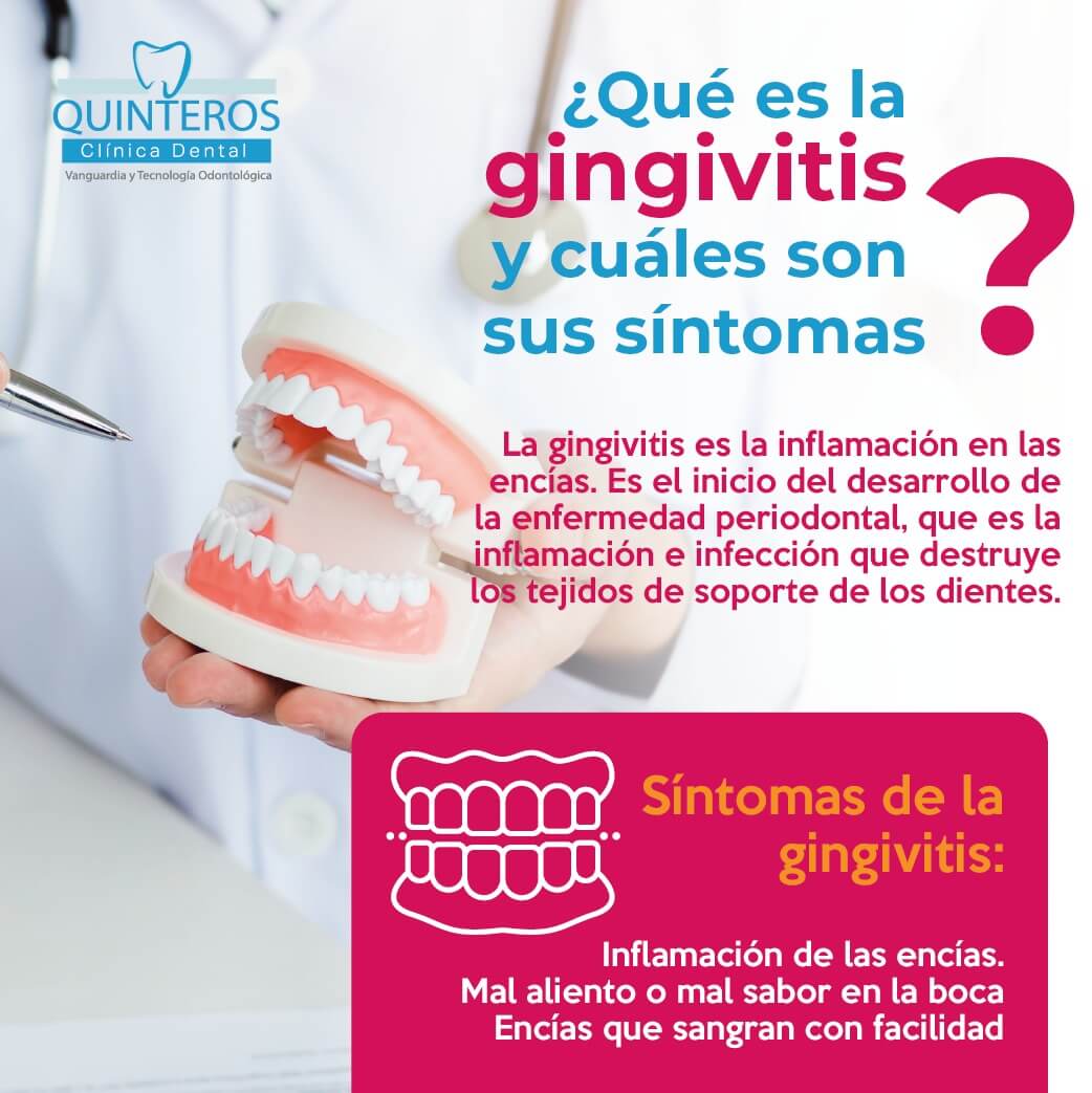 ¿Qué es la gingivitis? ¿Cuáles son sus síntomas?