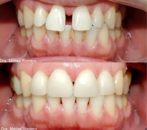 Separación Dientes