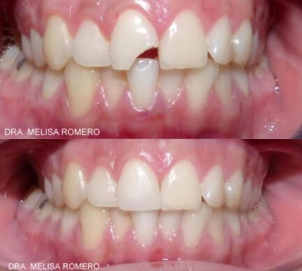 Fractura Coronaria