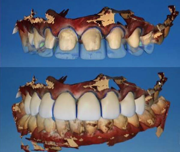 Tecnología CADCAM CEREC